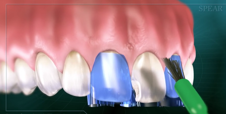 Composite Filling (Anterior)