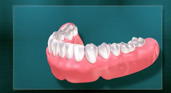 Removable Complete Dentures