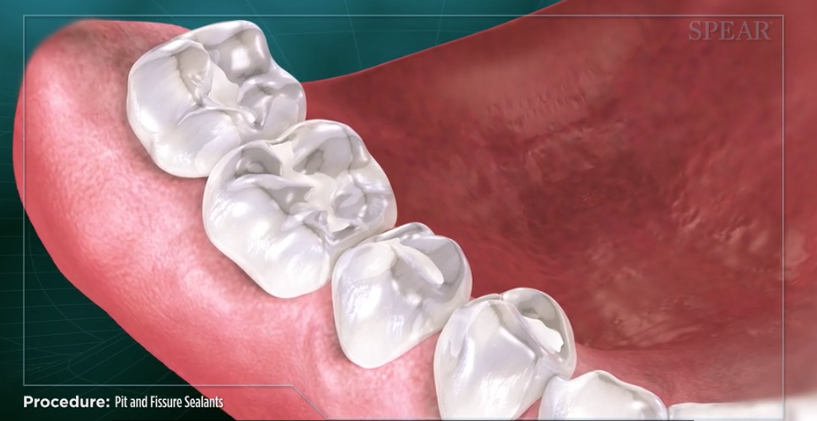 Pit and Fissure Sealants